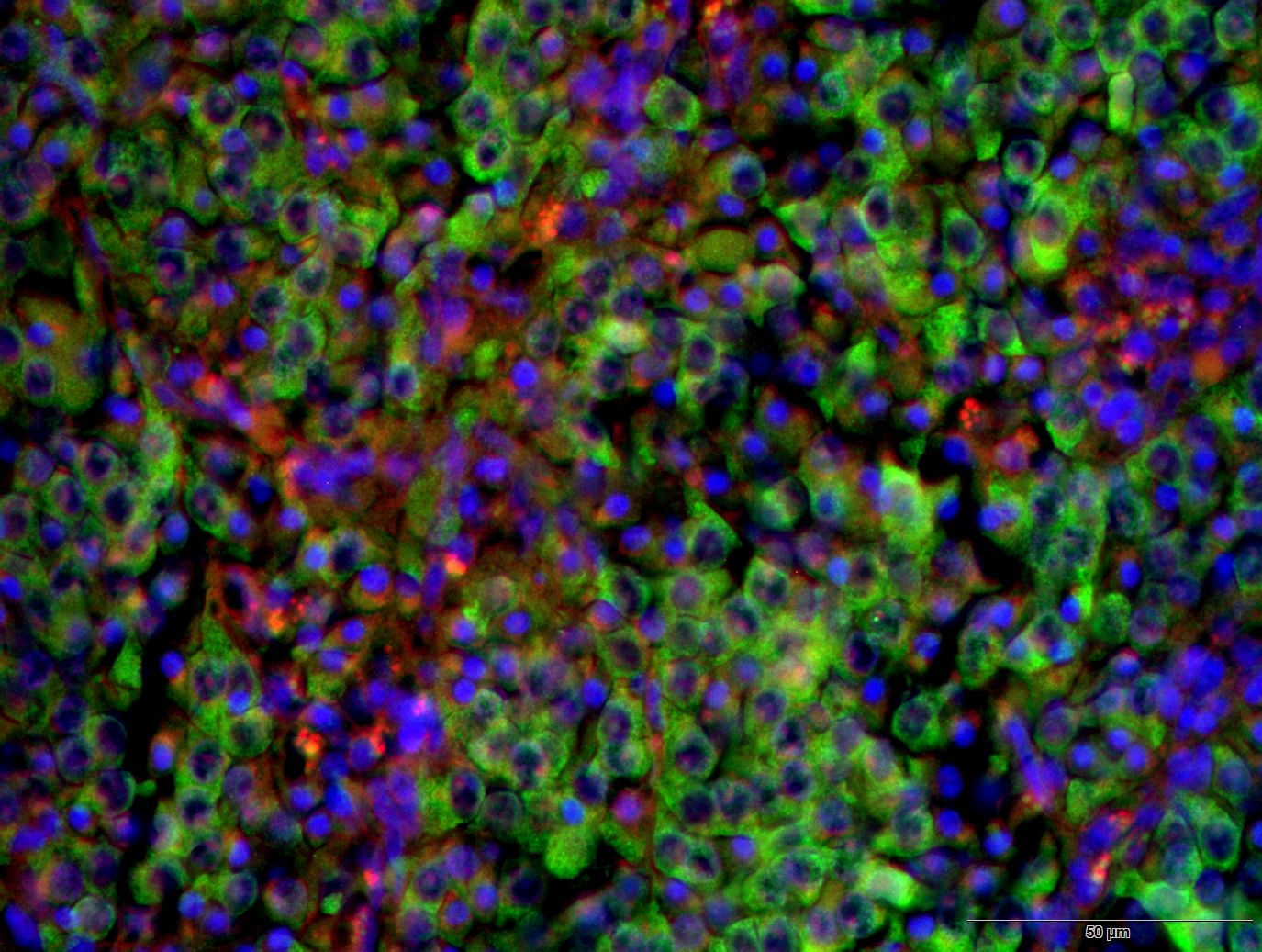 Neuroblastomzellen (grün) in der Nebenniere. Zellkerne sind blau angefärbt.
