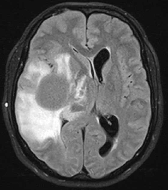 Axiale MRT-Aufnahme des Gehirns in FLAIR-Sequenz mit einem großen, rundlichen Areal erhöhter Signalintensität in der linken Hemisphäre, umgeben von ausgedehnten hellen Veränderungen im umliegenden Gewebe. Die Struktur verdrängt angrenzende Hirnanteile und führt zu einer Verschiebung der Mittellinie sowie einer Einengung des nahegelegenen Seitenventrikels. Mehrere unterschiedlich helle Zonen innerhalb und um die Läsion zeigen unregelmäßige Begrenzungen und ein inhomogenes Erscheinungsbild.
